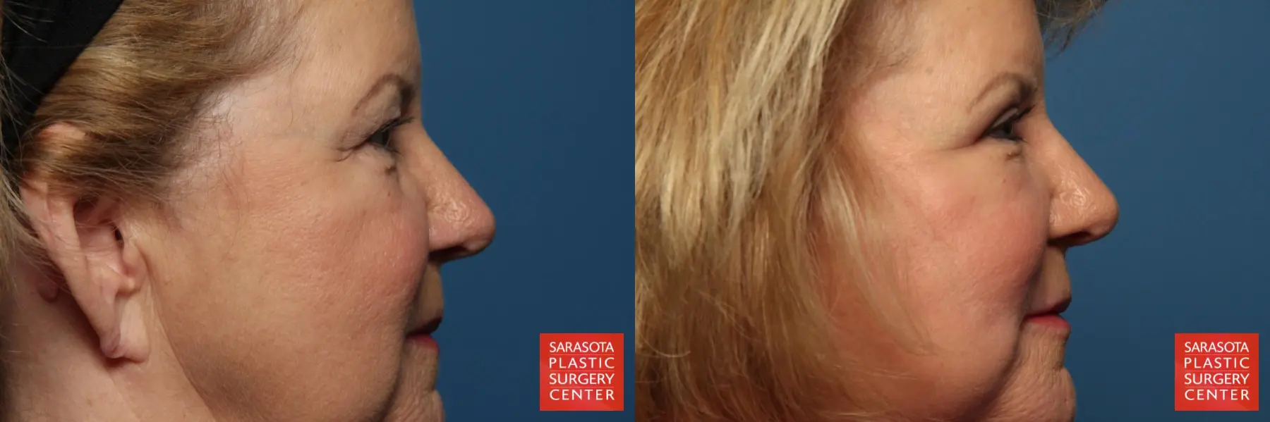 Eyelid Lift: Patient 33 - Before and After 5
