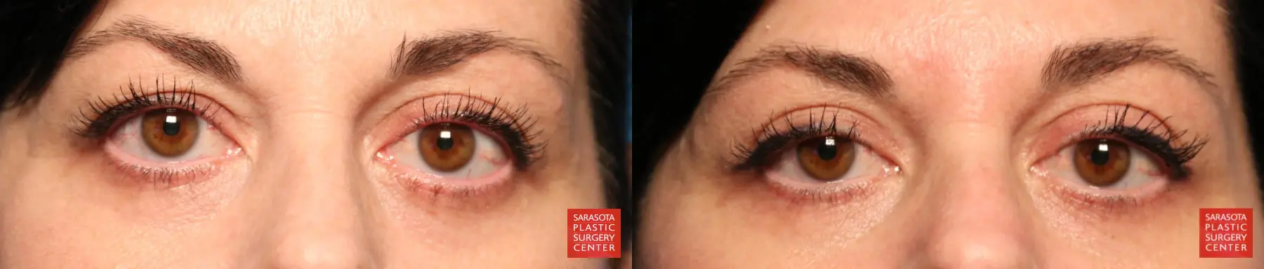 Eyelid Lift: Patient 15 - Before and After 1