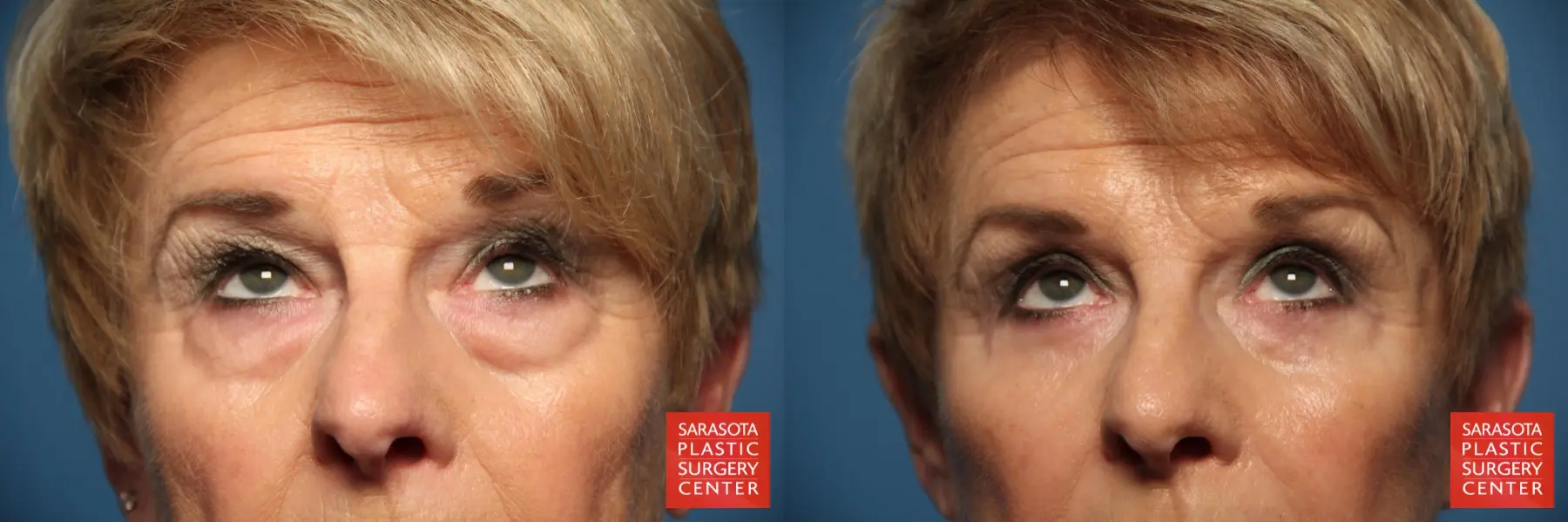 Eyelid Lift: Patient 11 - Before and After 2