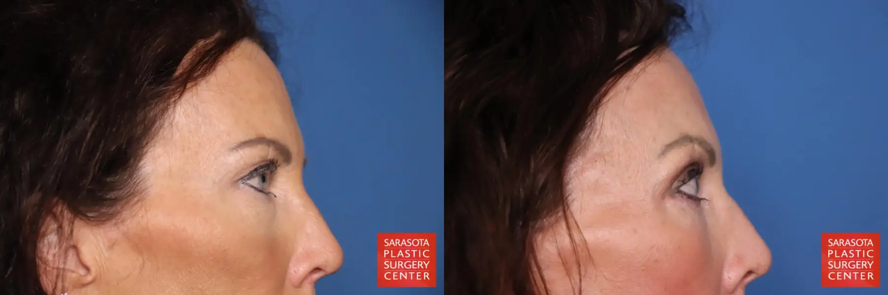 Eyelid Lift: Patient 64 - Before and After 5