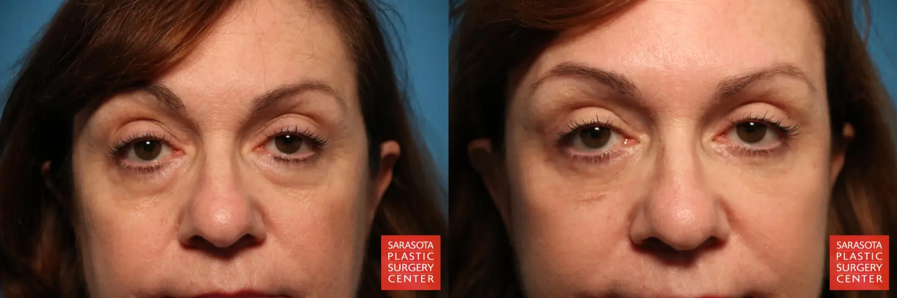 Eyelid Lift: Patient 31 - Before and After 1