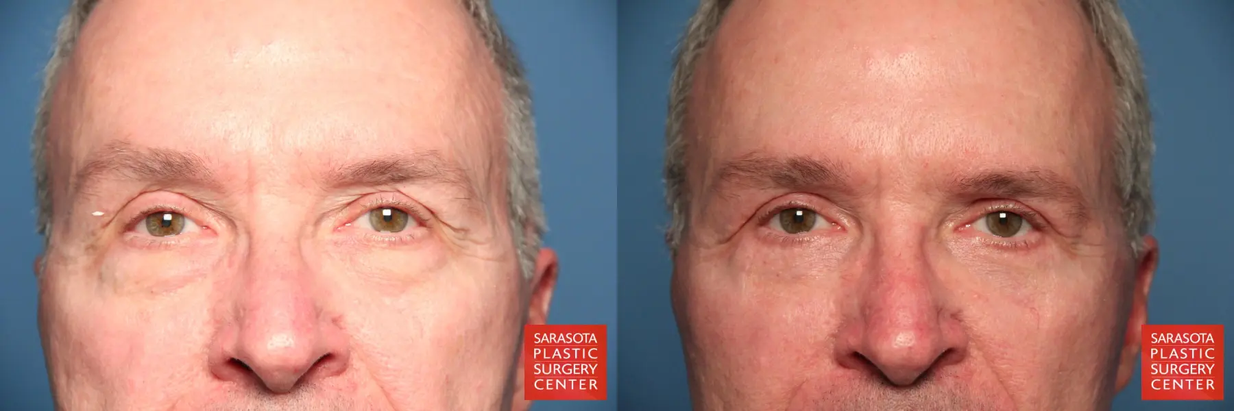 Eyelid Lift For Men Revision: Patient 1 - Before and After 1