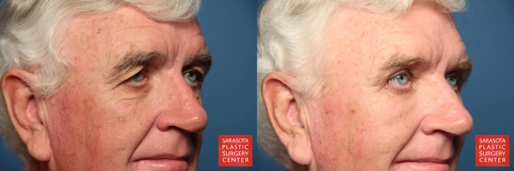 Eyelid Lift For Men: Patient 1 - Before and After 2