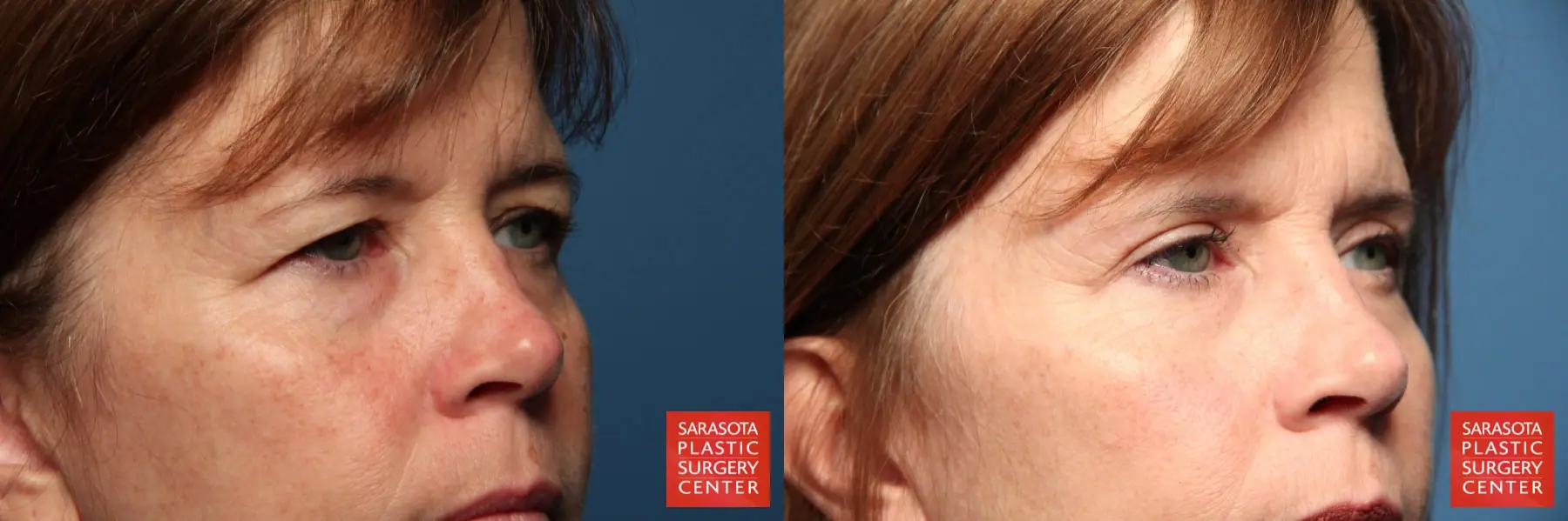 Eyelid Lift: Patient 37 - Before and After 2