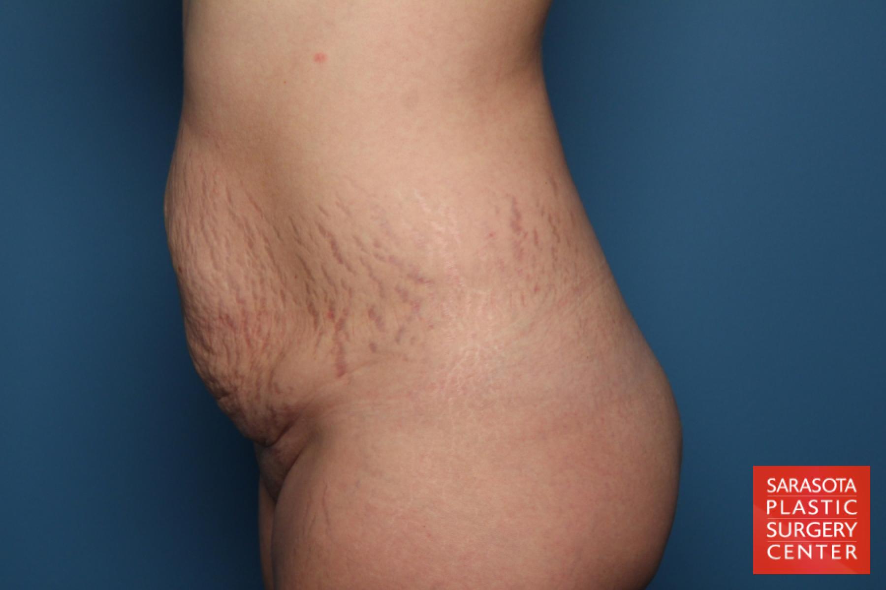 Tummy Tuck: Patient 21 - Before and After 3