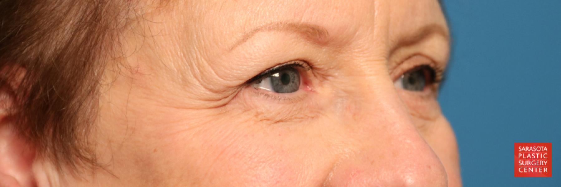 Eyelid Lift: Patient 20 - Before 4