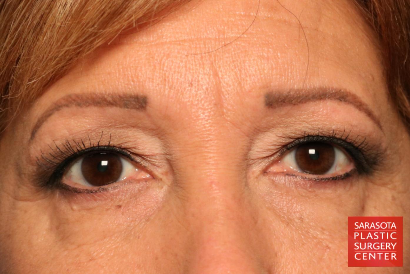 Eyelid Lift: Patient 9 - Before 