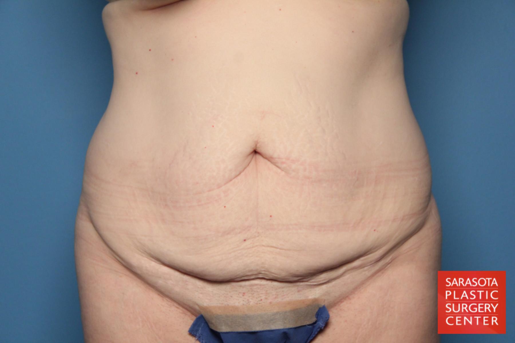 Tummy Tuck: Patient 17 - Before 1