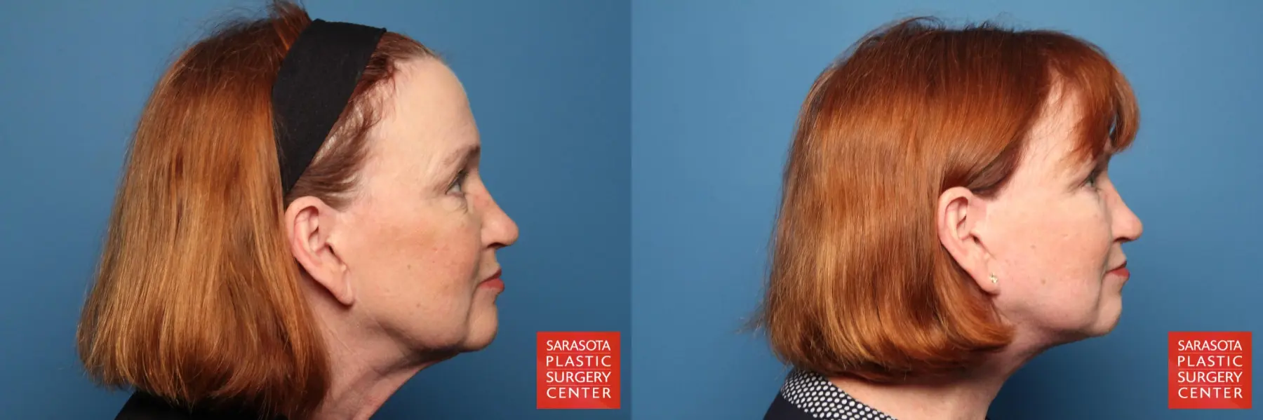 Facelift: Patient 33 - Before and After 3