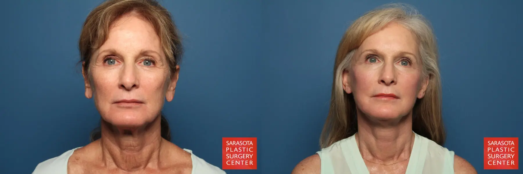 Facelift: Patient 9 - Before and After  