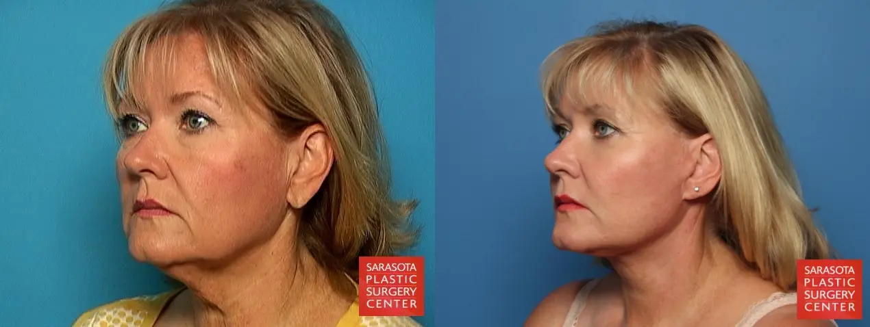 Facelift: Patient 4 - Before and After 2