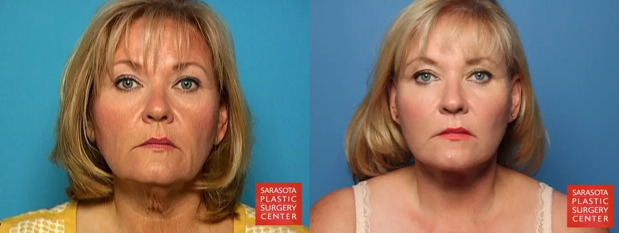 Facelift: Patient 4 - Before and After  