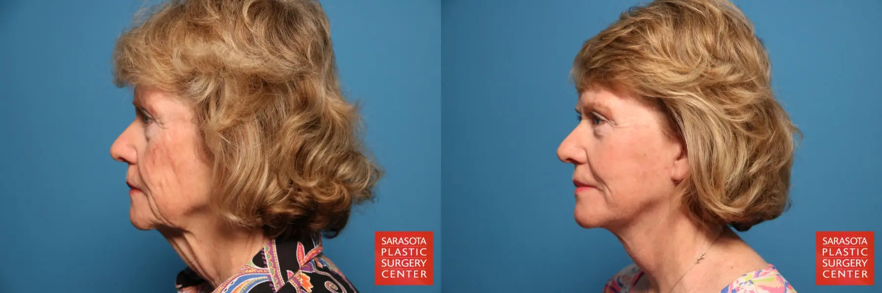 Facelift: Patient 8 - Before and After 3