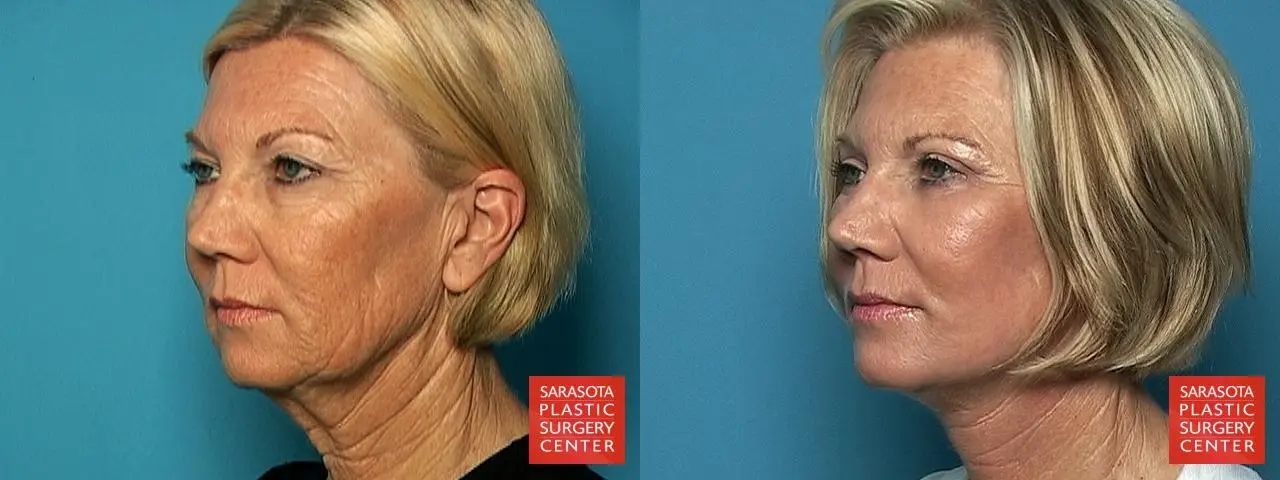 Facelift: Patient 2 - Before and After 2