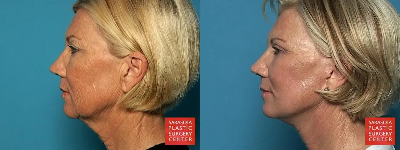Facelift: Patient 3 - Before and After 3