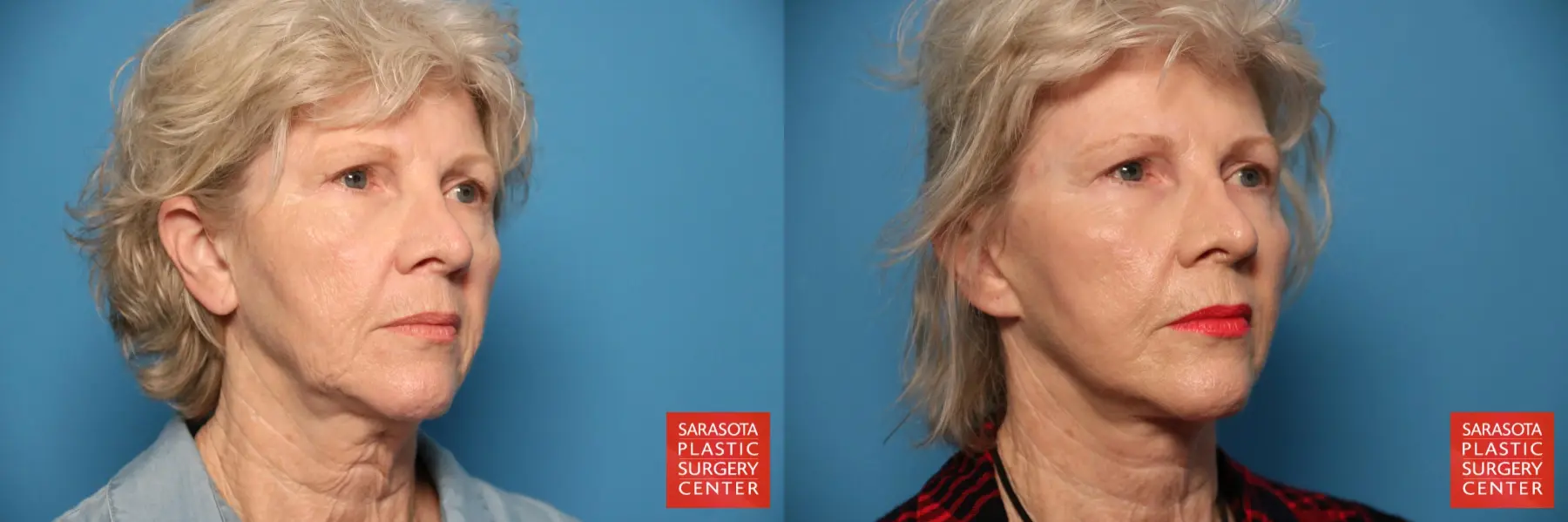 Facelift: Patient 22 - Before and After 2