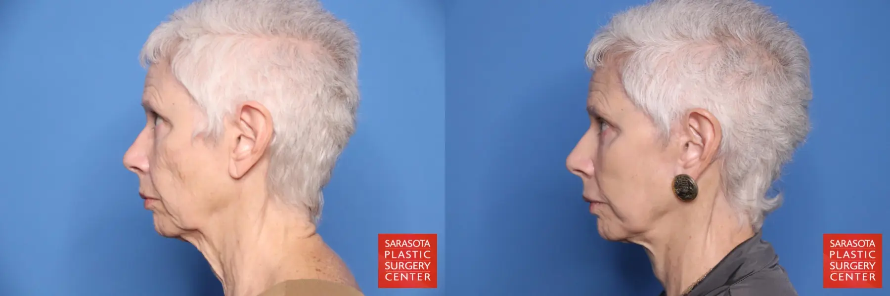 Facelift: Patient 58 - Before and After 3
