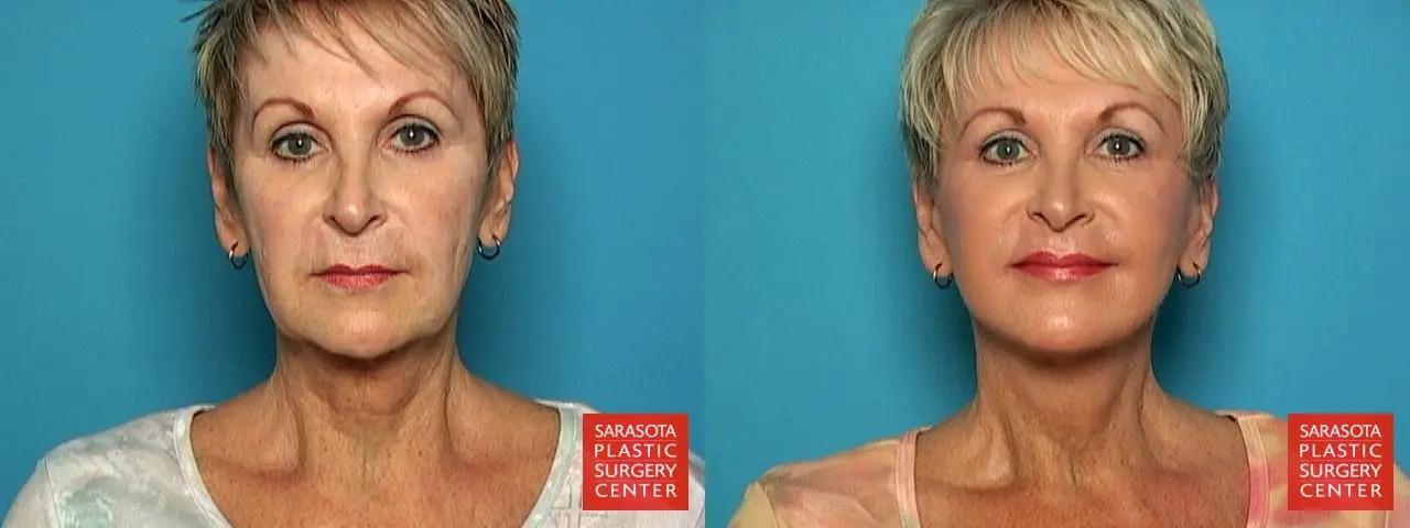 Sarasota Facelift  - Before and After 1