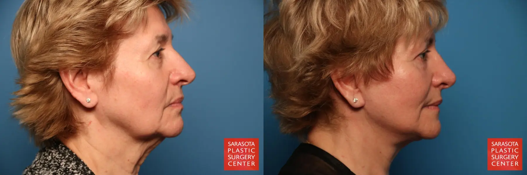 Facelift: Patient 34 - Before and After 3