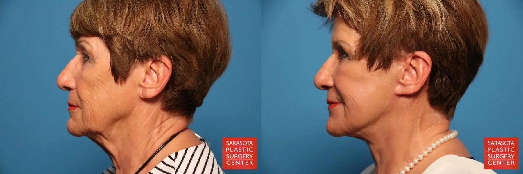 Facelift: Patient 18 - Before and After 3