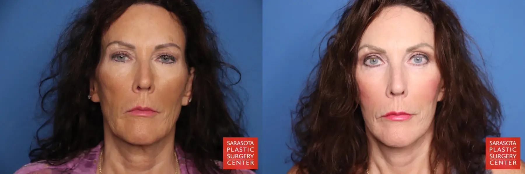 Facelift: Patient 101 - Before and After 1