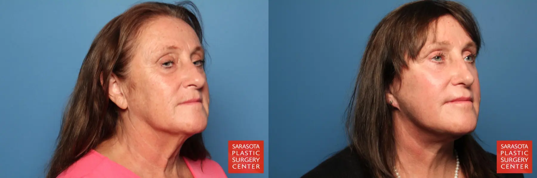 Facelift: Patient 16 - Before and After 2