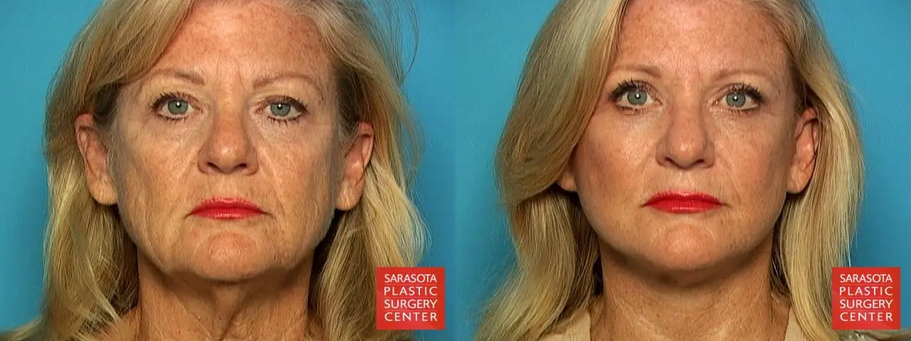 Facelift: Patient 3 - Before and After 1