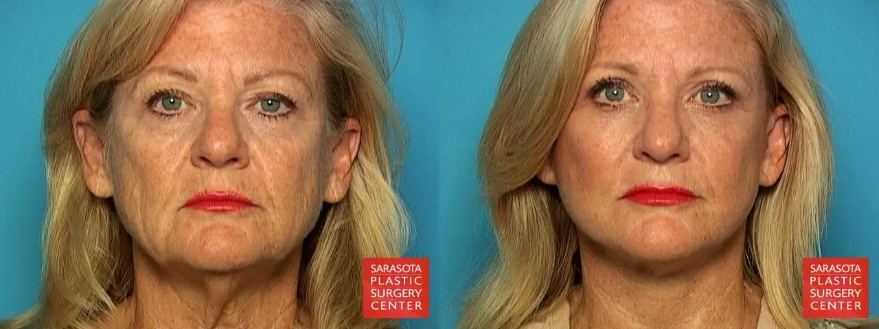 Facelift: Patient 3 - Before and After  