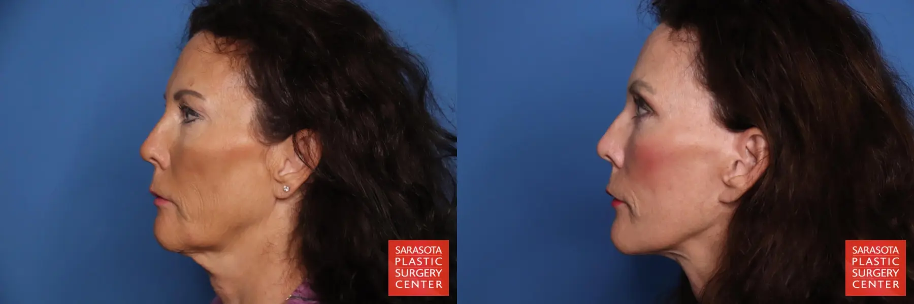 Facelift: Patient 101 - Before and After 3