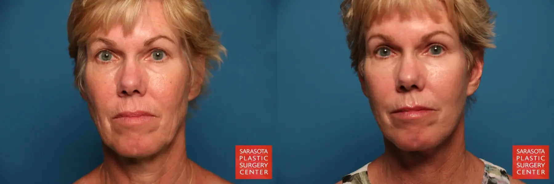 Facelift: Patient 8 - Before and After  