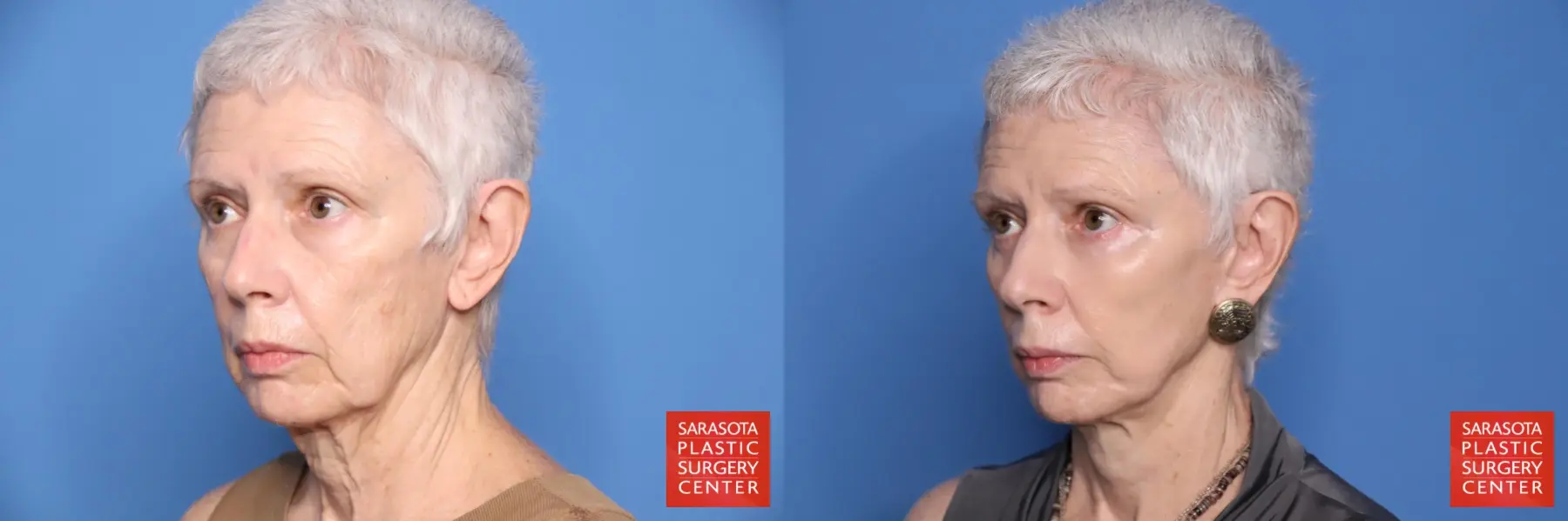 Facelift: Patient 58 - Before and After 2