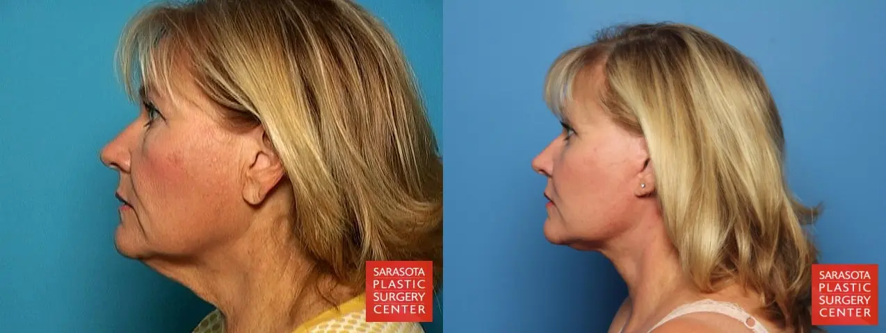 Facelift: Patient 6 - Before and After 3