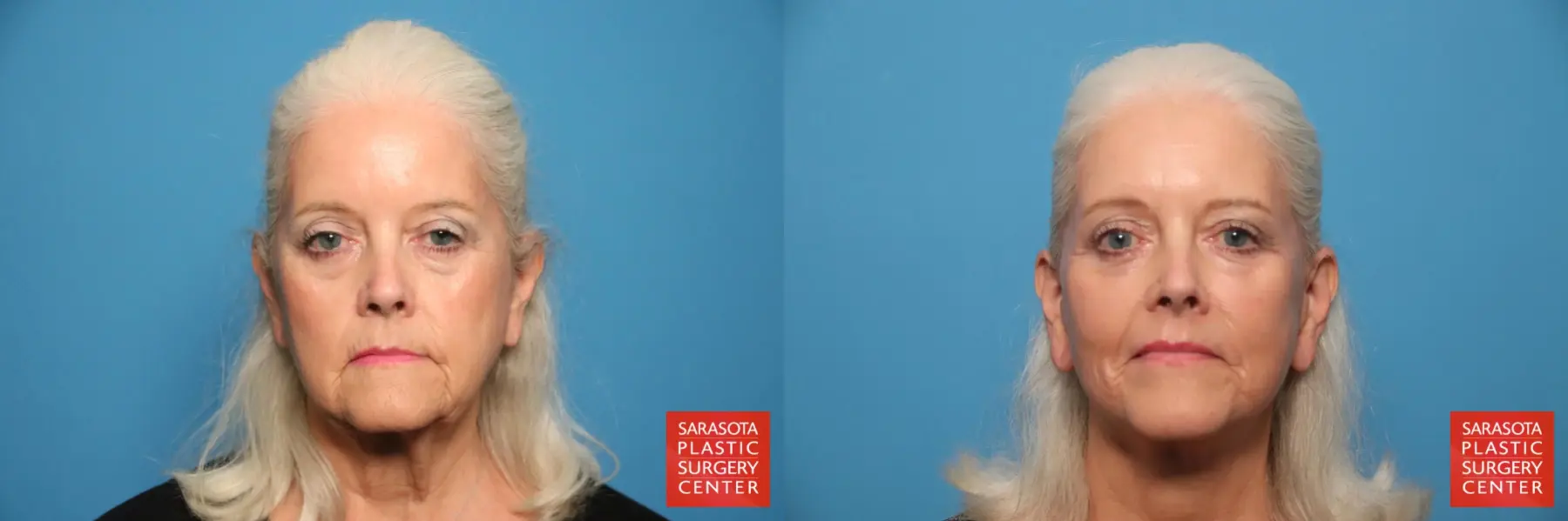 Facelift: Patient 62 - Before and After 1