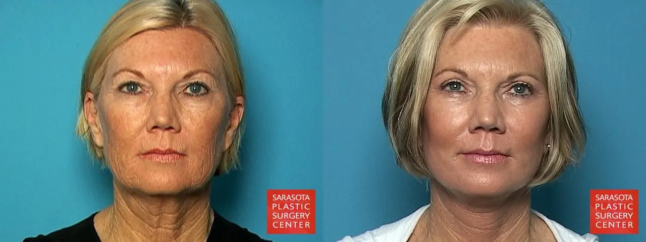 Facelift: Patient 2 - Before and After  