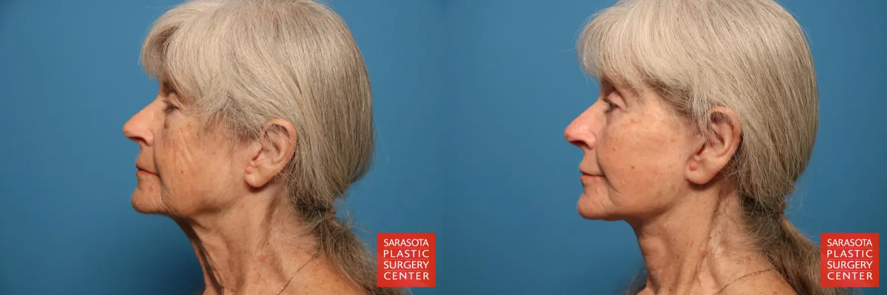 Facelift Revision: Patient 1 - Before and After 3