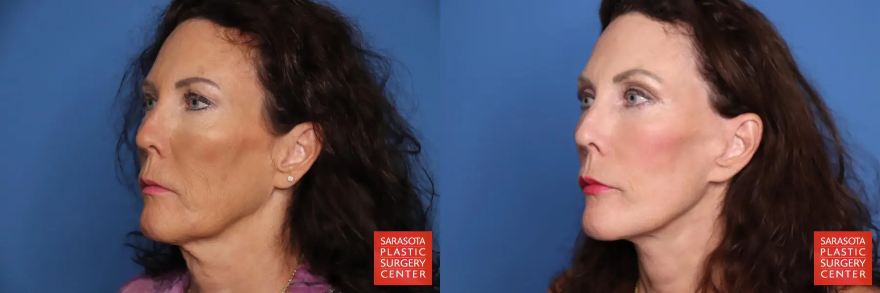 Facelift: Patient 101 - Before and After 2