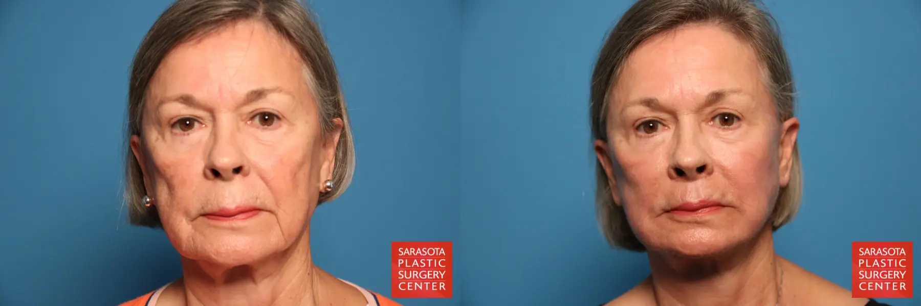 Facelift: Patient 20 - Before and After 1