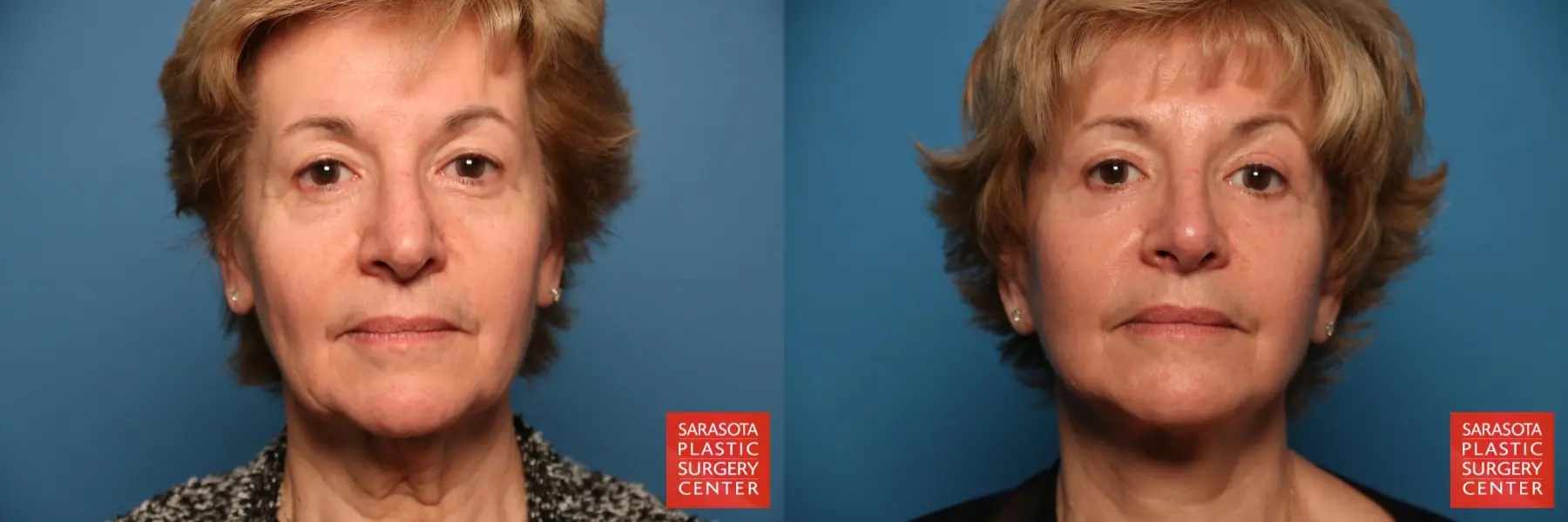 Facelift: Patient 34 - Before and After 1