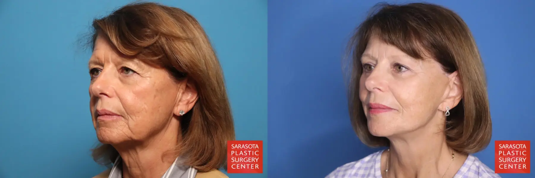 Facelift: Patient 66 - Before and After 2
