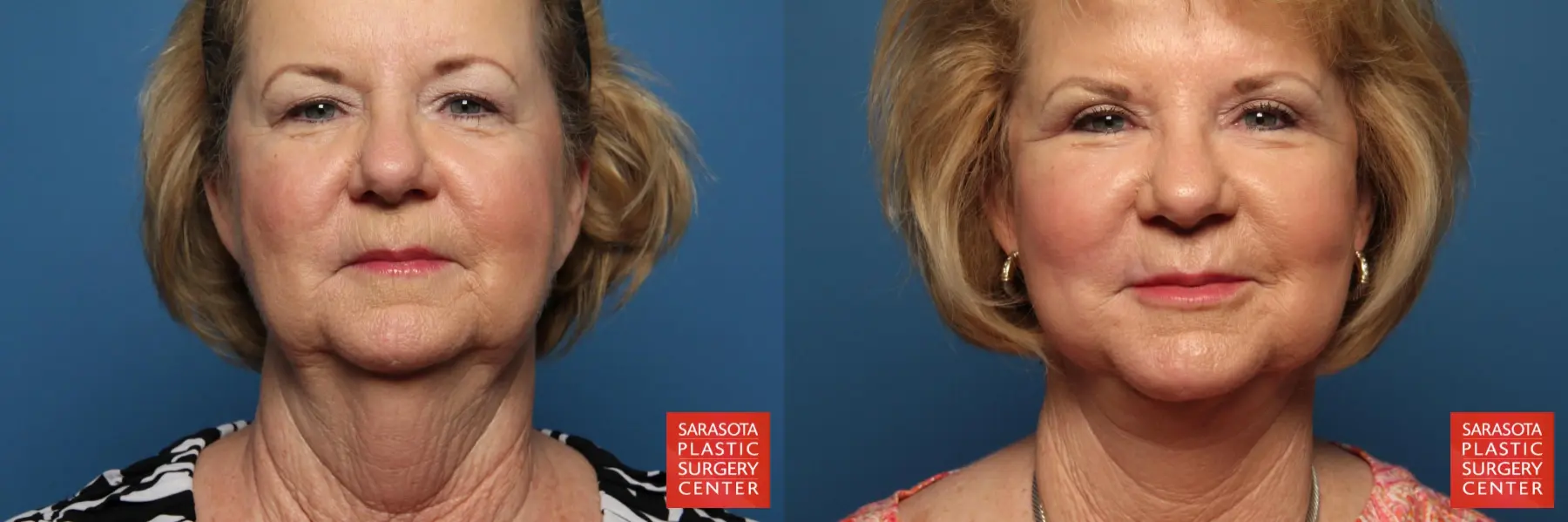 Facelift: Patient 11 - Before and After 1