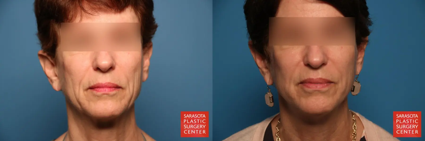 Facelift: Patient 25 - Before and After  