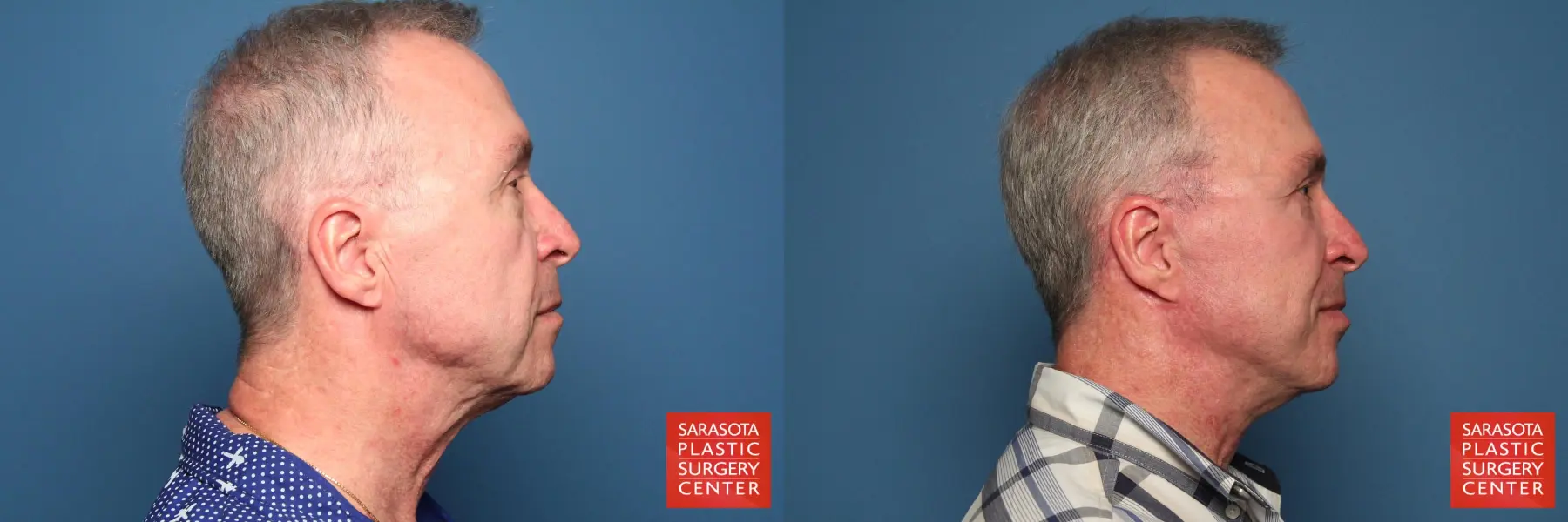 Facelift For Men: Patient 2 - Before and After 3