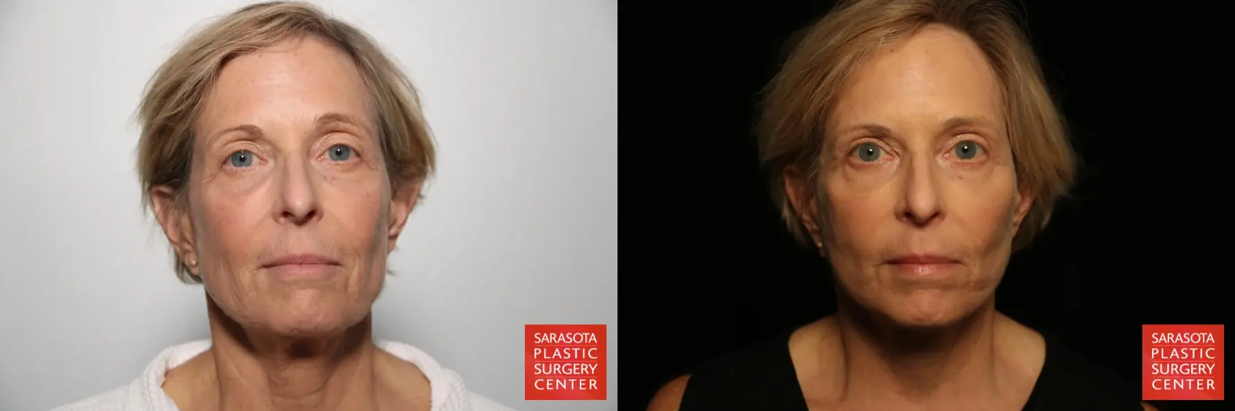 Facelift: Patient 43 - Before and After 1