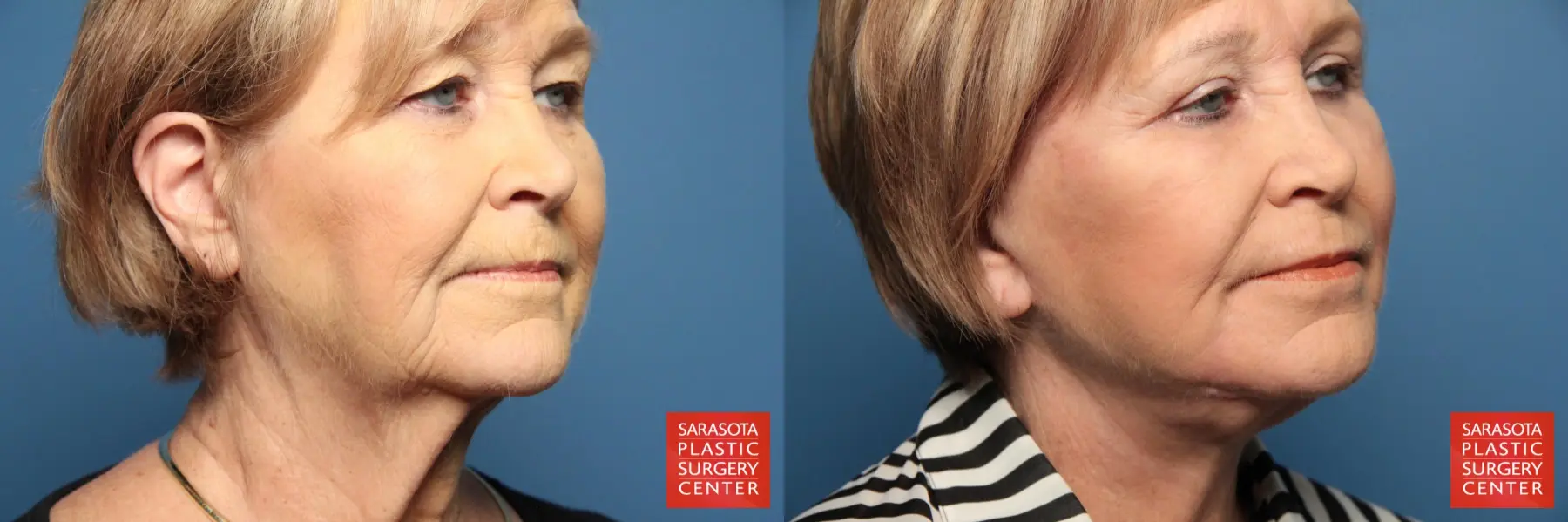 Facelift: Patient 32 - Before and After 2
