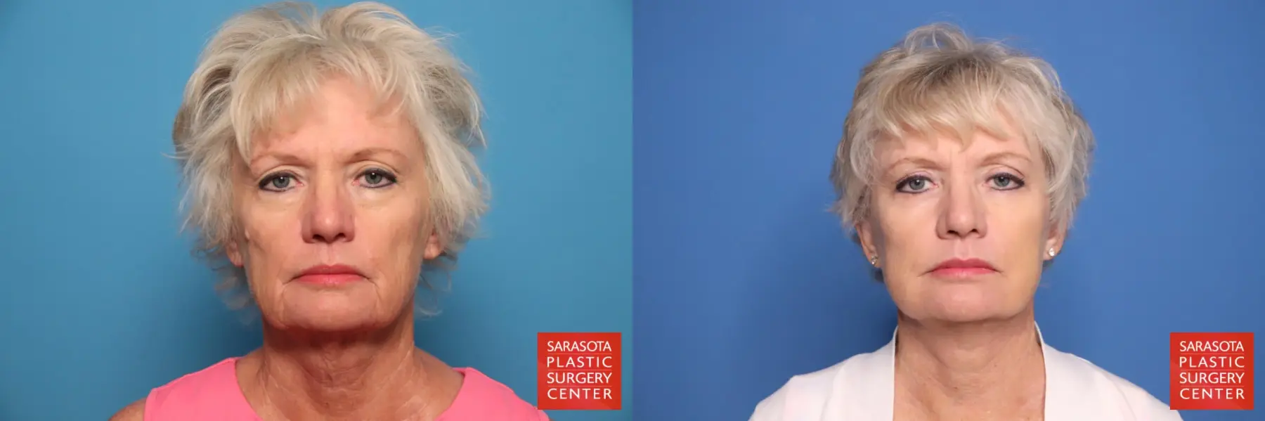 Facelift: Patient 53 - Before and After 1