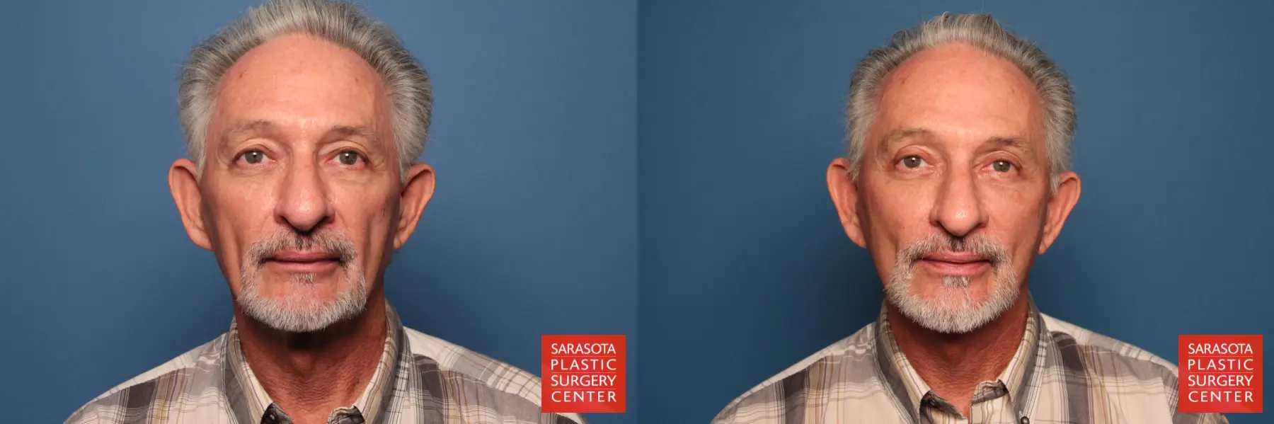 Facelift For Men: Patient 1 - Before and After 1