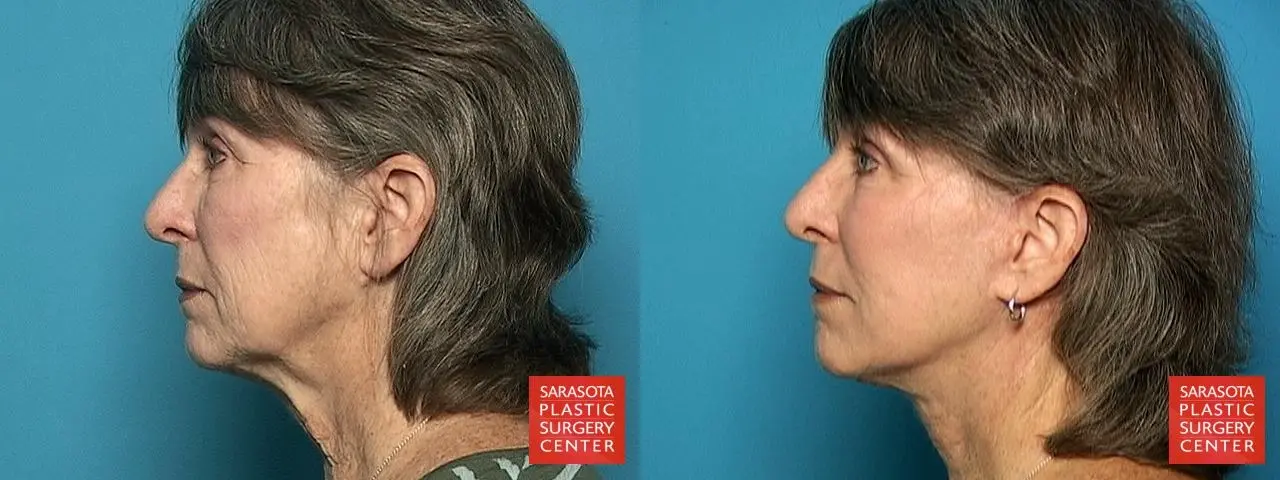 Facelift: Patient 19 - Before and After 3