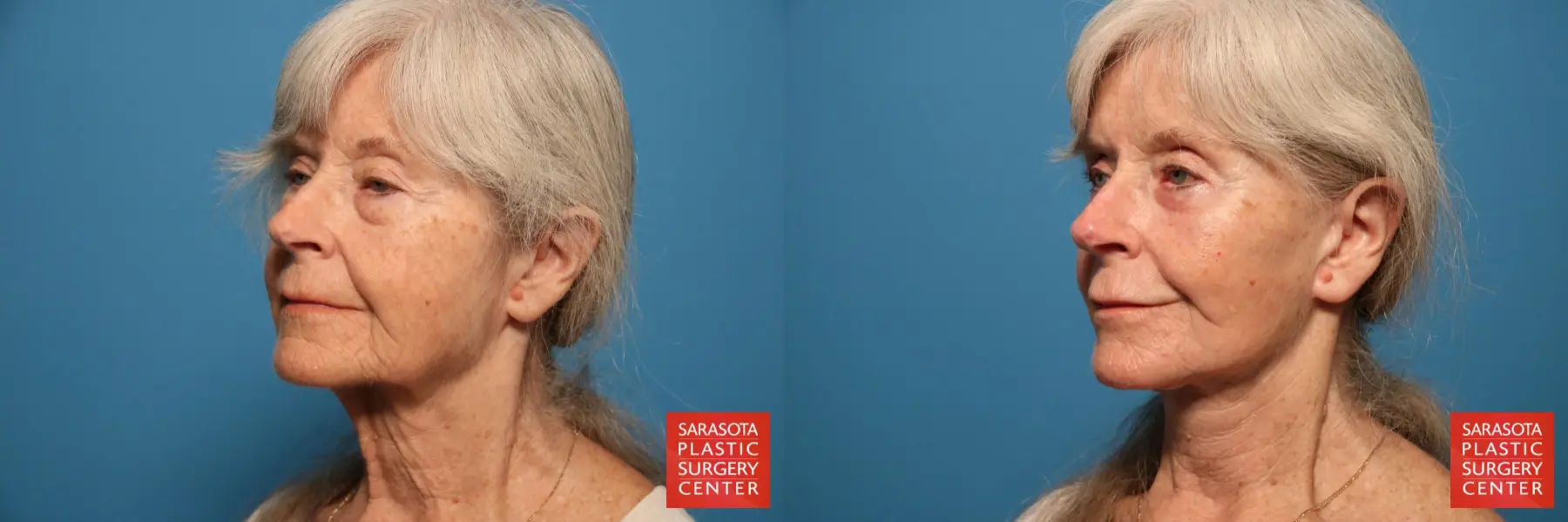 Facelift Revision: Patient 1 - Before and After 2