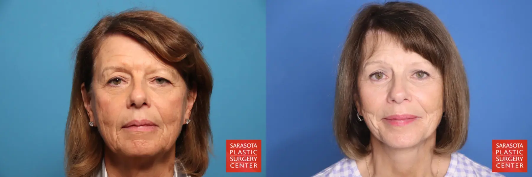 Facelift: Patient 66 - Before and After 1