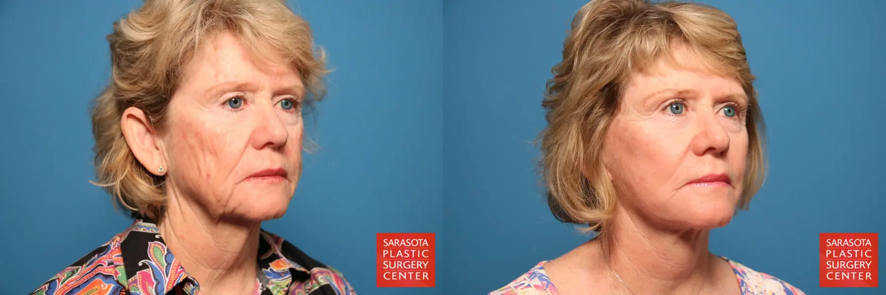 Facelift: Patient 8 - Before and After 4